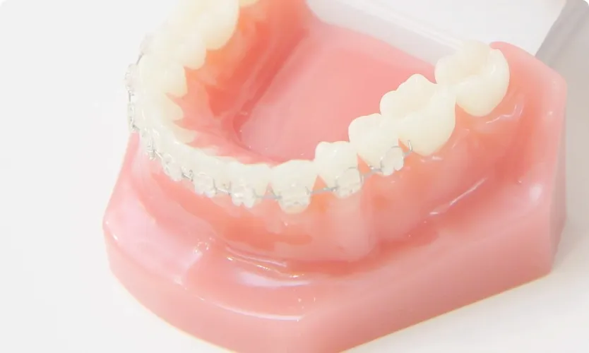 表側ブラケット矯正