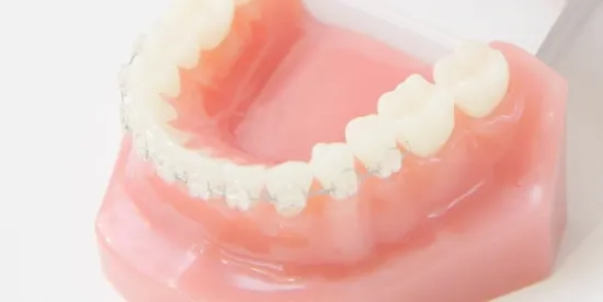 表側ブラケット矯正