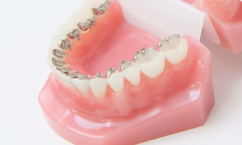 裏側・ハーフリンガル矯正