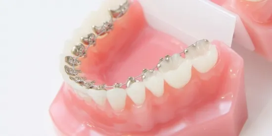 裏側・ハーフリンガル矯正